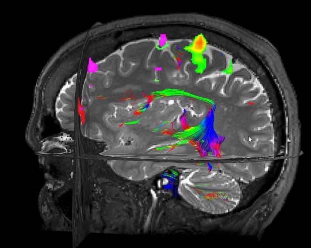 Functional Magnetic Resonance Imaging (fMRI) » Department of Neurology » College of Medicine » University of Florida