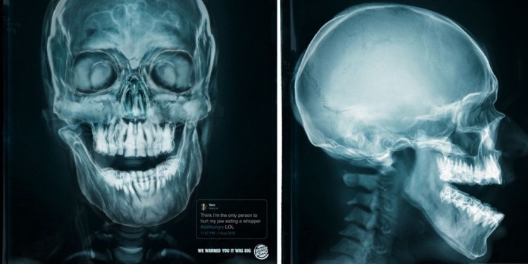 Burger King Built Ads From X-Rays of Customers Who Hurt Their Jaws Eating Whoppers