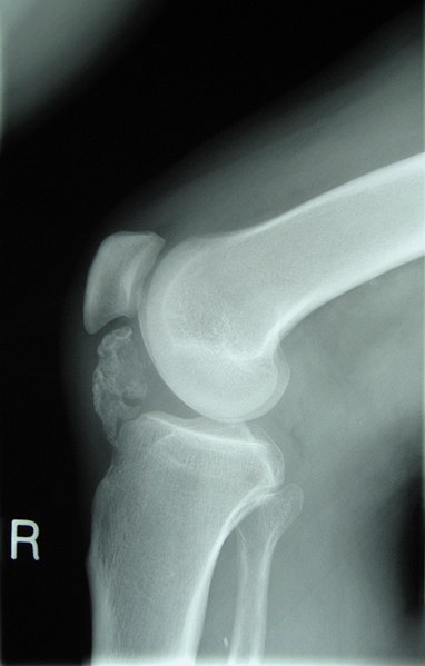 Archivo:Osteochondroma X-ray.jpg - Wikipedia, la enciclopedia libre