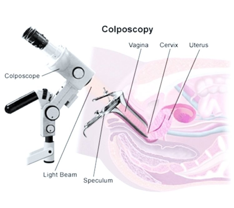 Balanced Women's Health: Colposcopy - POYNOR HEALTH