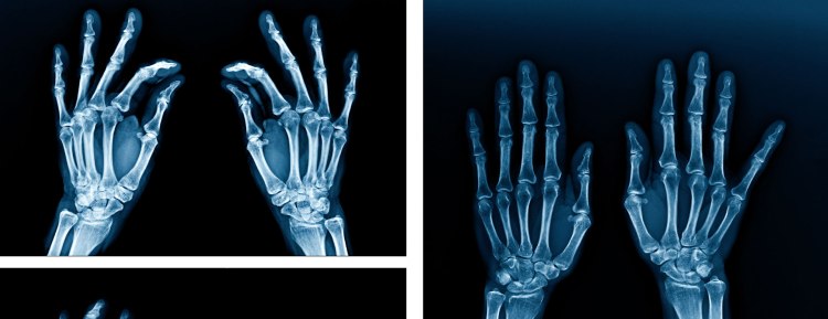 X-Rays - Johns Hopkins Medicine