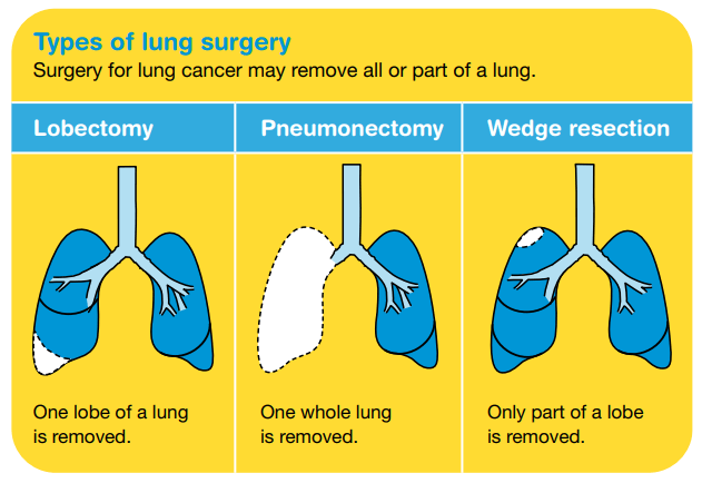 Lung cancer treatment - Cancer Council Victoria