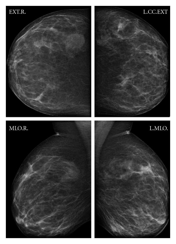 mammography