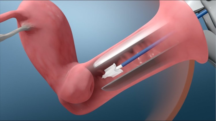 gynecological ultrasound