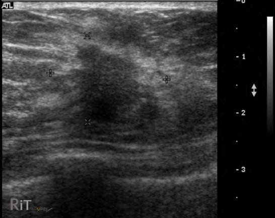 breast ultrasound