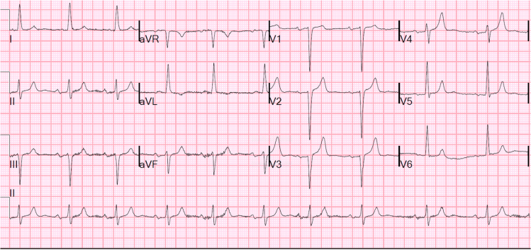 ekg